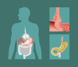 Hiatal hernia diagram