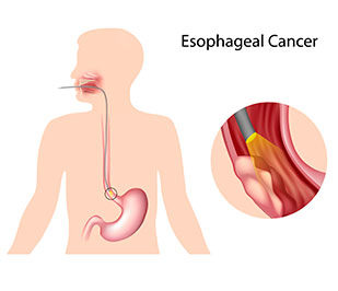 Upper endoscopy for esophageal cancer screening