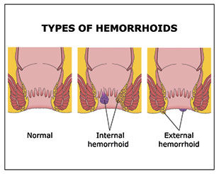 The three different types of hemorrhoids